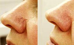 фото проявления купероза на носу